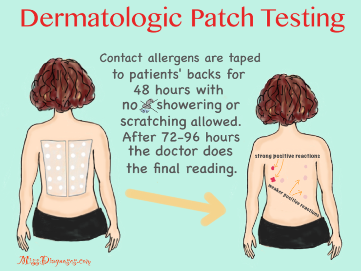 Drawing of dermatological patch testing